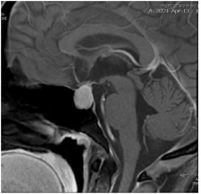 First Episode Psychosis and Pituitary Hyperplasia in a Patient With Untreated Hashimoto’s Thyroiditis: A Case Report